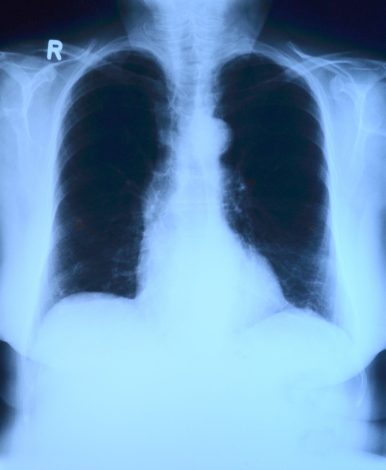 PNEUMOTORACE SPONTANEO IN PRONTO SOCCORSO ENGLISH VERSION